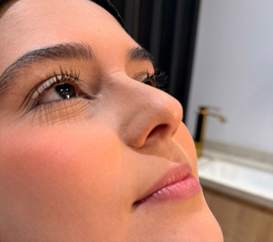 Antes — Rinomodelação e preenchimento labial