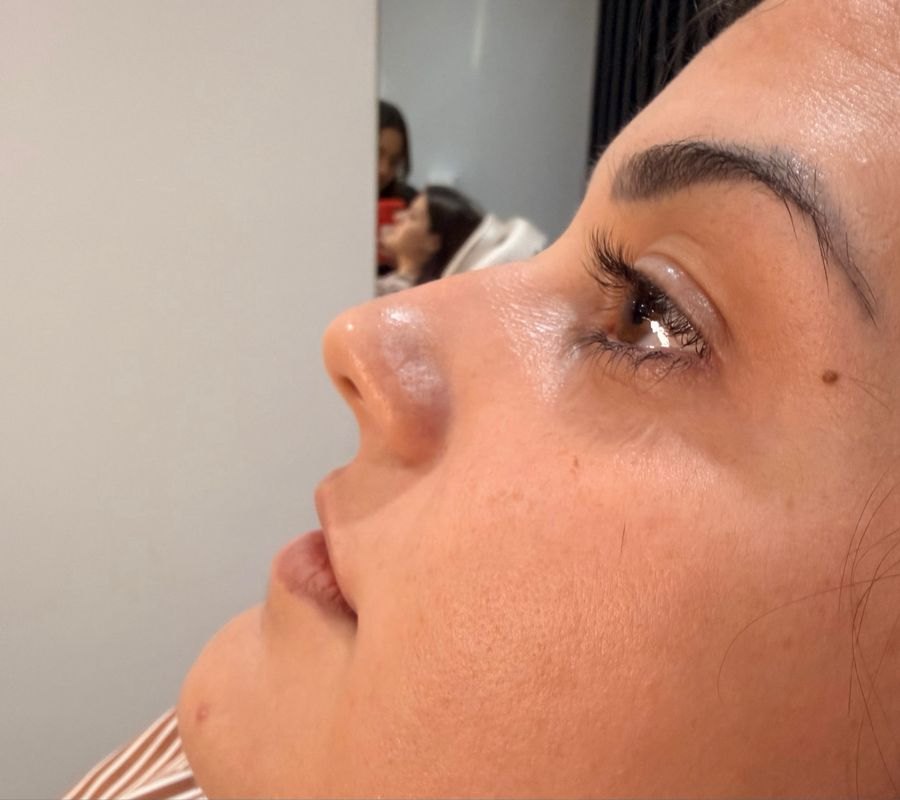 Antes — Rinomodelação e preenchimento labial