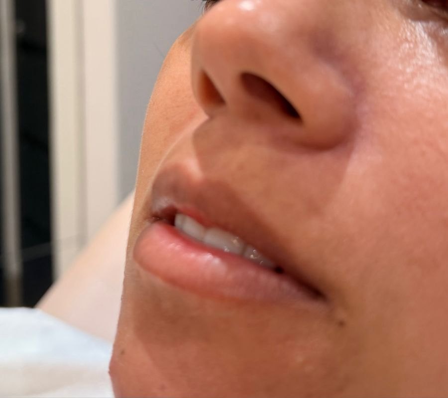 Antes — Preenchimento labial