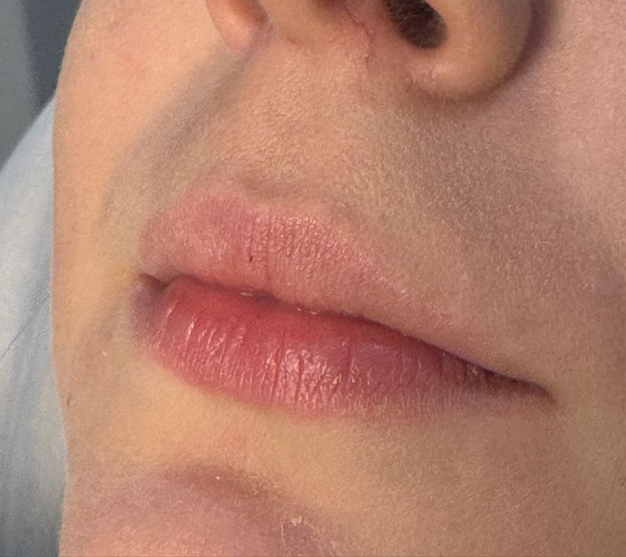 Antes — Preenchimento labial
