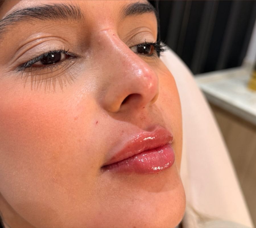 Resultado de rinomodelação e preenchimento labial