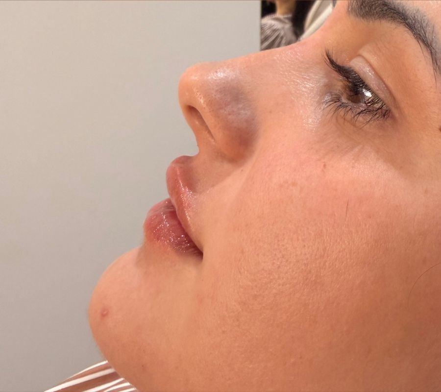 Depois — Rinomodelação e preenchimento labial