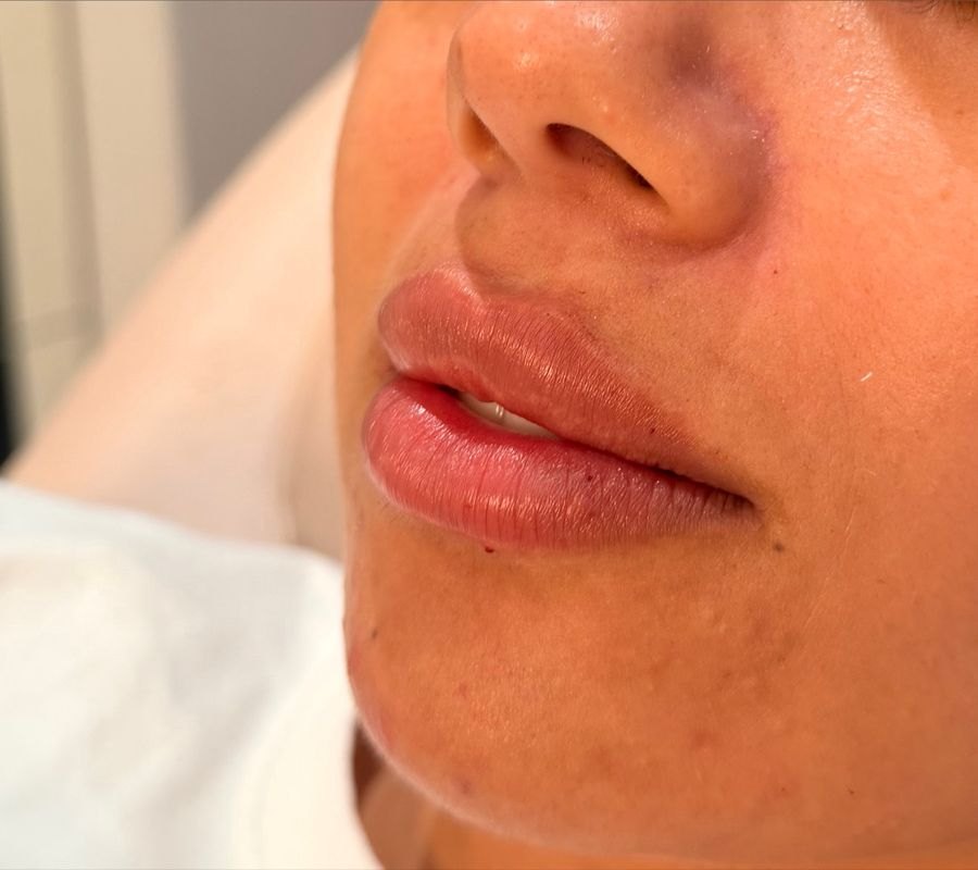 Resultado de preenchimento labial