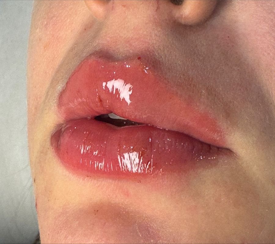 Depois — Preenchimento labial