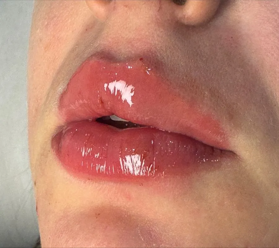 Depois — Preenchimento labial