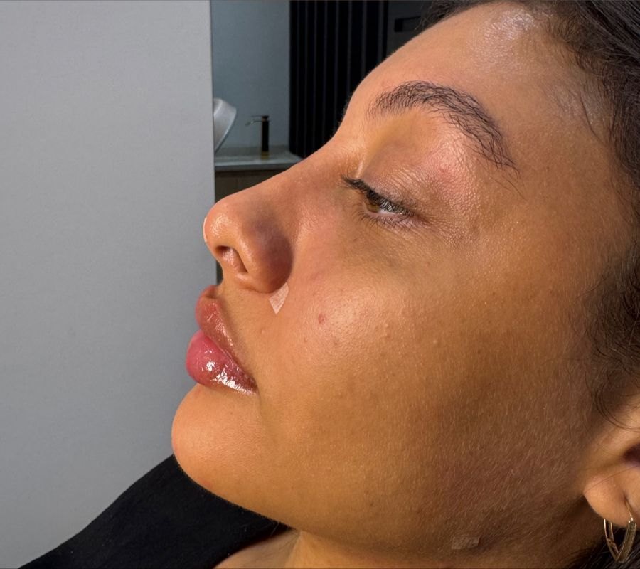 Resultado de rinomodelação e contorno facial